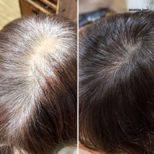 تاثیر شامپو ضدریزش بیوکسین مخصوص موهای چرب تاثیر شامپو ضدریزش بیوکسین مخصوص موهای چرب